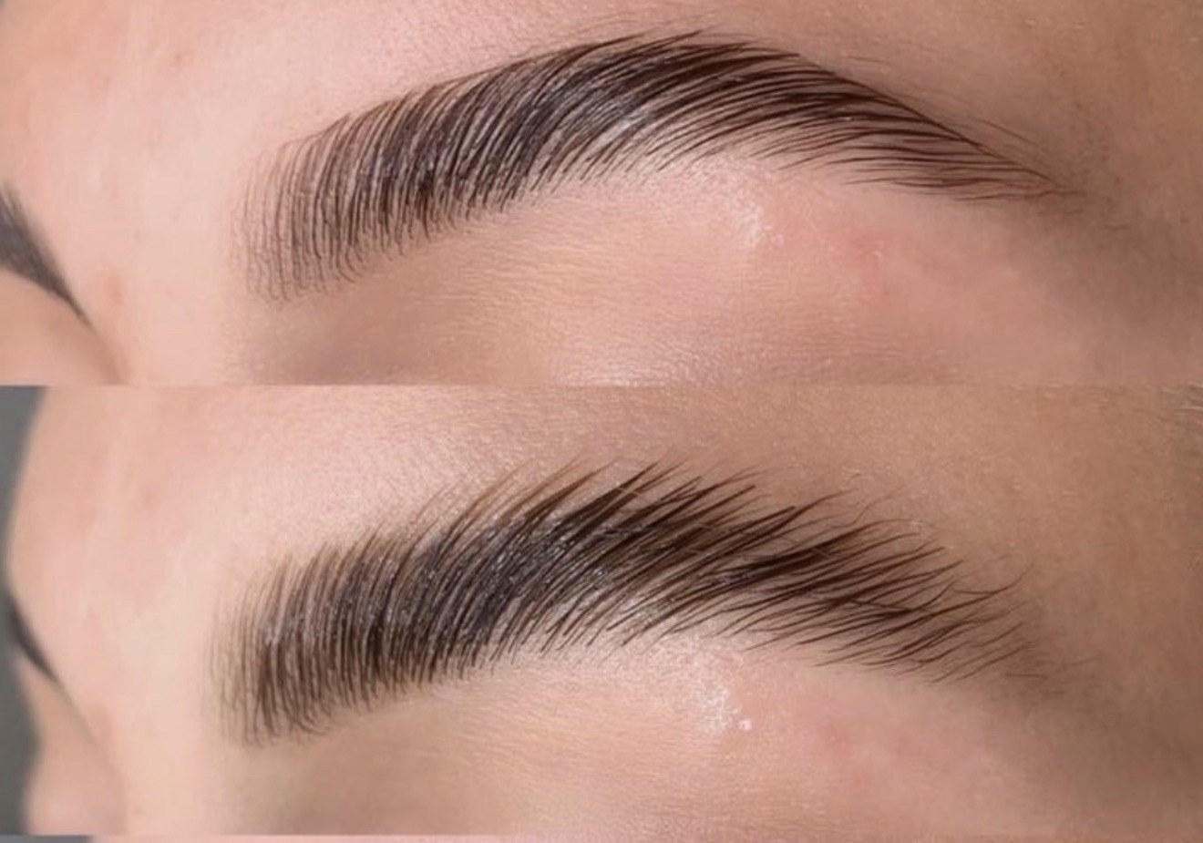Brow Lifting Vorher Nachher
